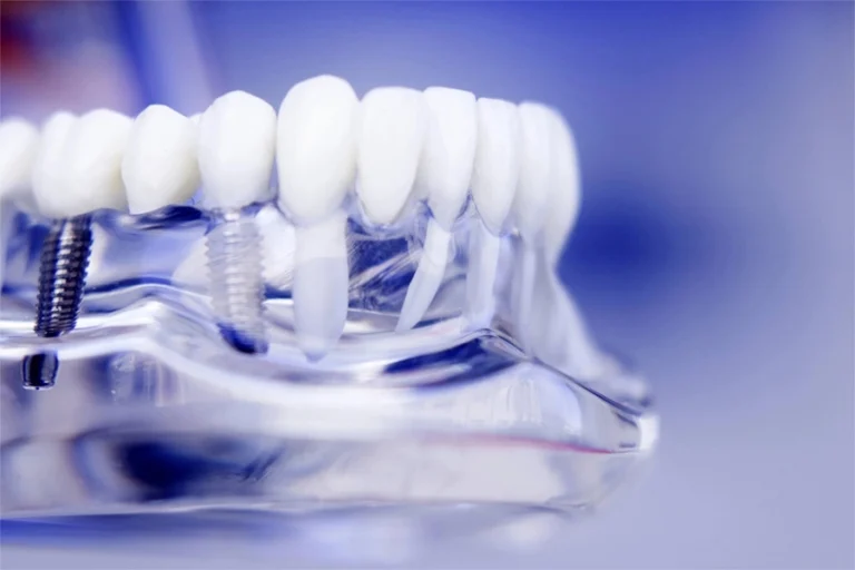 huge-dental-lmplant-solution